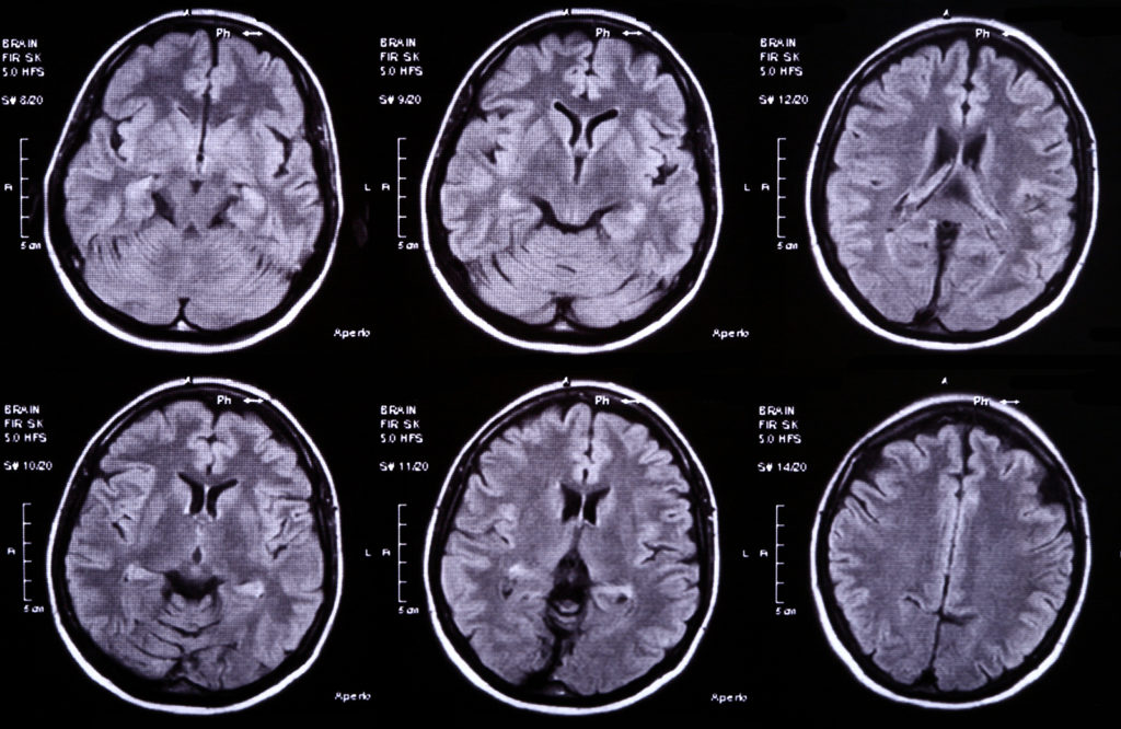 X-ray Image Of The Brain