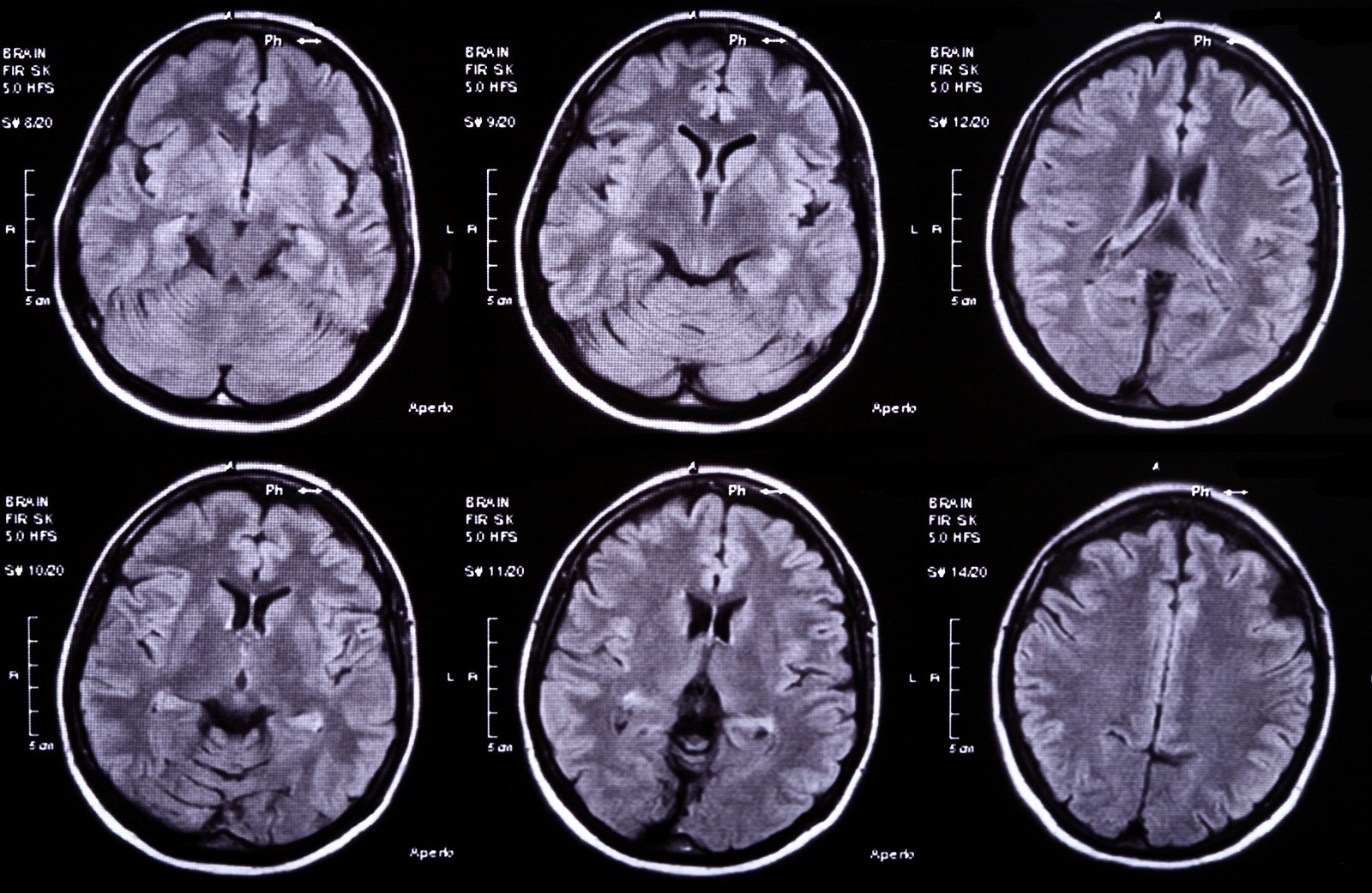 xray of brain scan